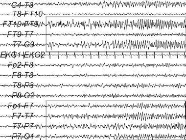 First Adult Seizure: Background, Etiology, Epidemiology.